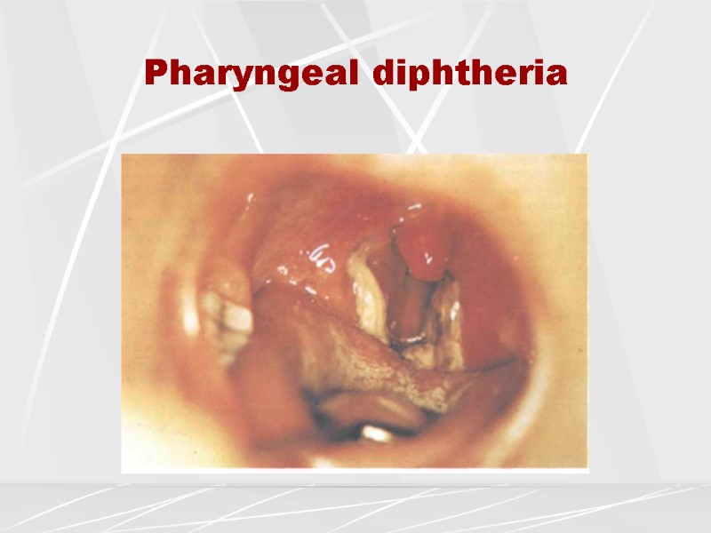 Pharyngeal diphtheria